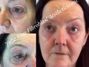 Before and after Fibroblast Eyelid & Under Eye treatment